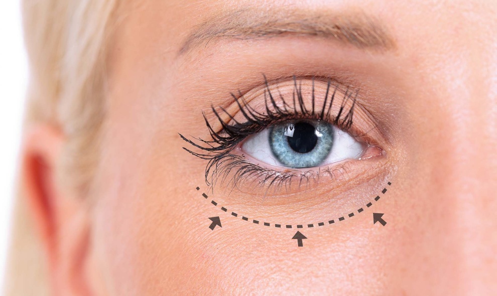 Lower eyelid plastic surgery