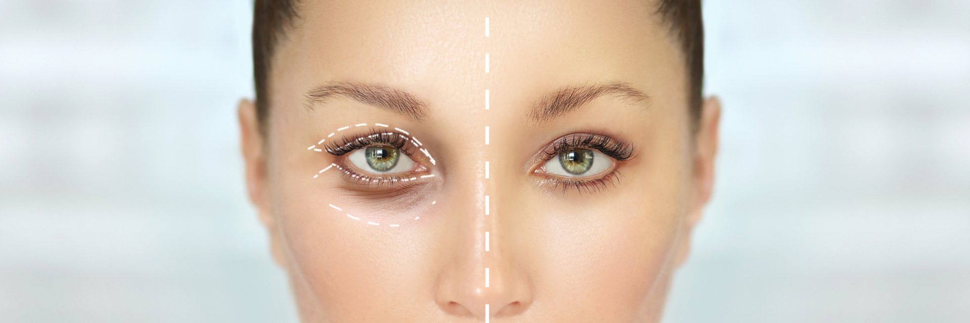 Seven detailed facts about eyelid surgery at MediEsté Clinic